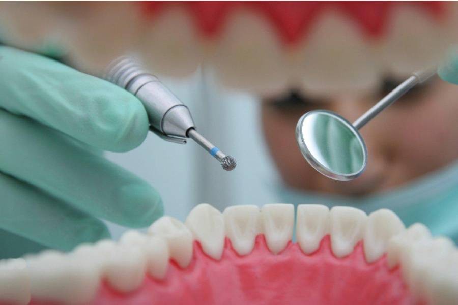 Plombe Dentare - Odontologie in Chisinau
