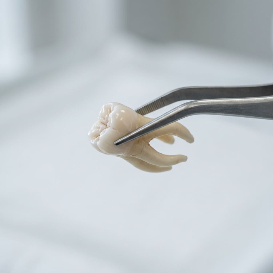 Îndepărtarea măselei de minte în Chișinău: doare sau nu și cum decurge procedura?