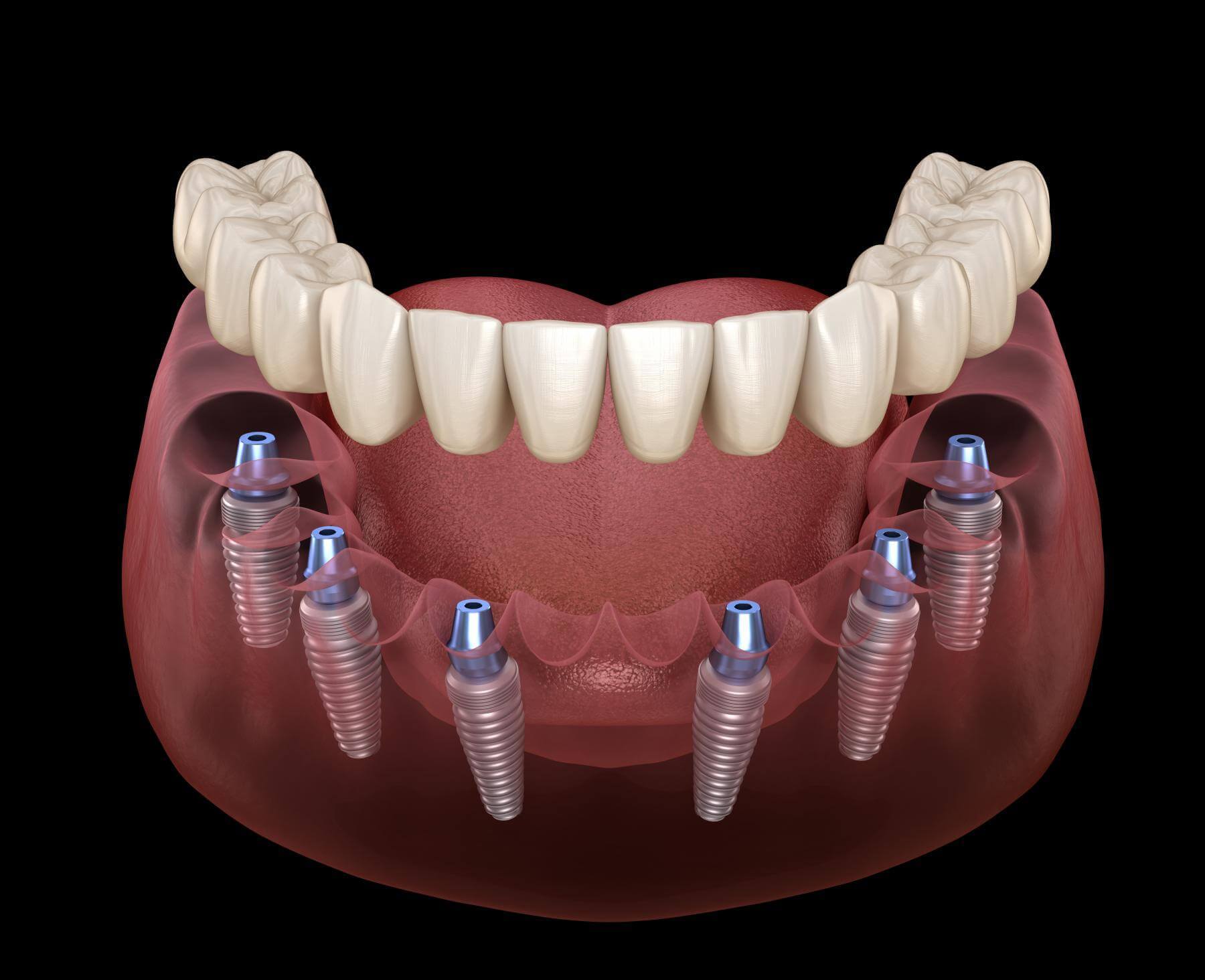 Denti fissi su 6 impianti –  “All - on – 6”– JD EVOLUTION 
